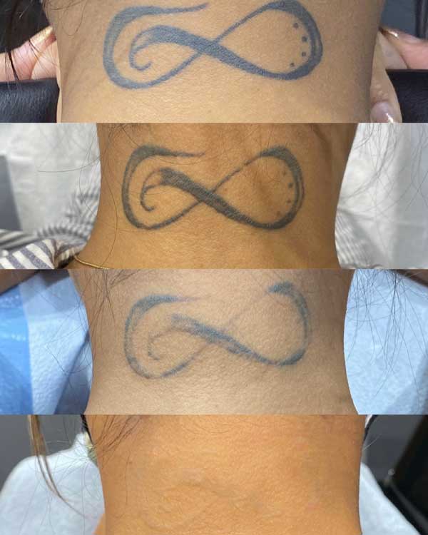 laser tattoo removal at 1 Point Tattoo