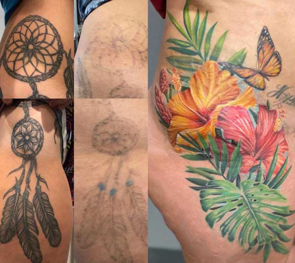 Laser tattoo removal at 1 Point Tattoo