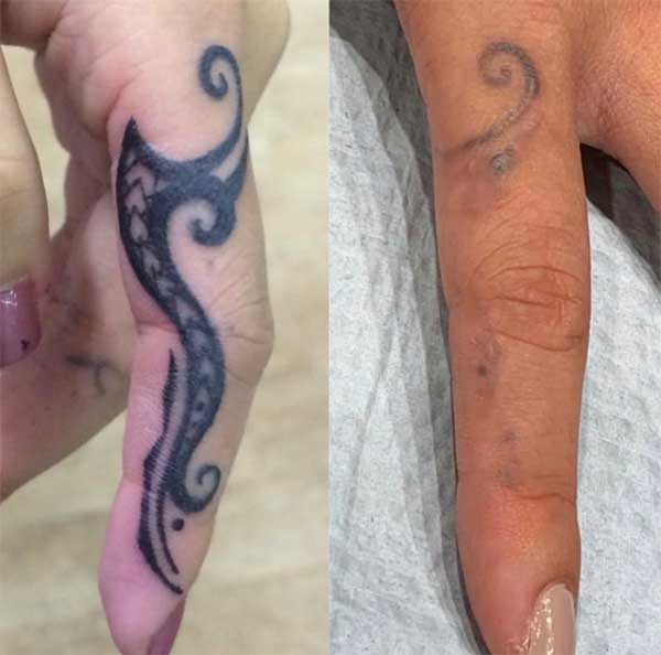 Laser Tattoo Removal Gallery | 1 Point Tattoo