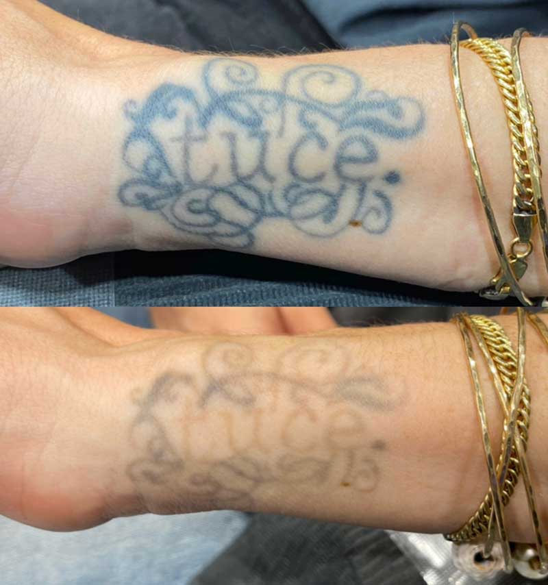 Laser tattoo removal at 1 Point Tattoo