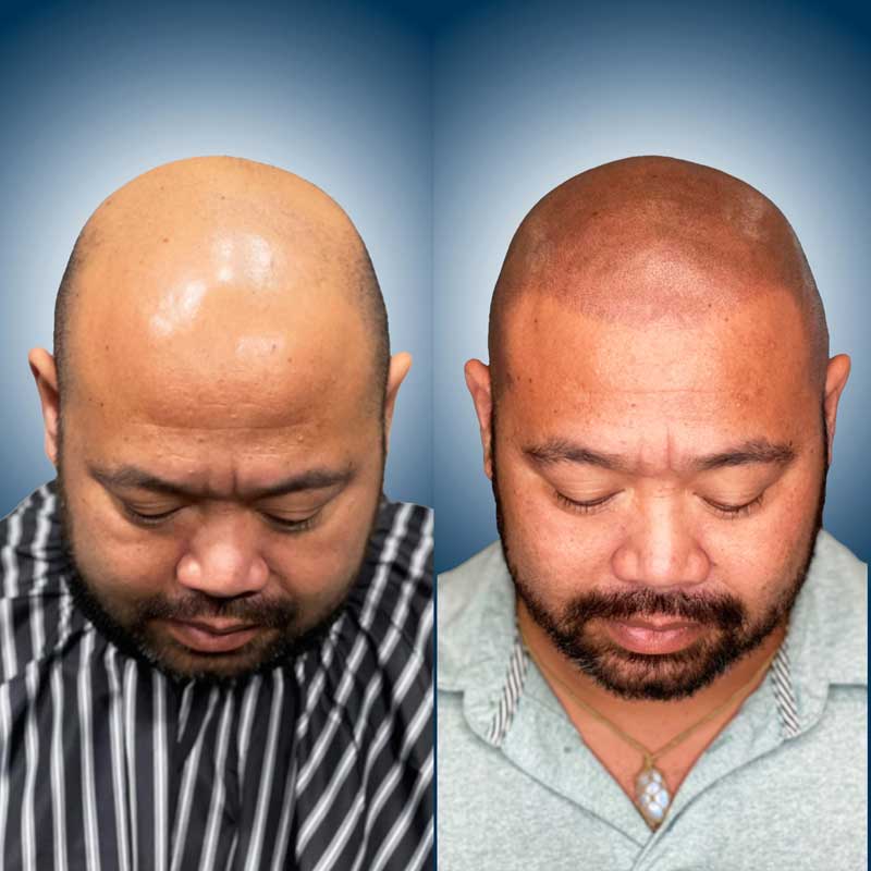 Hiarlien restoration with scalp micropigmentation at 1 Point Tattoo