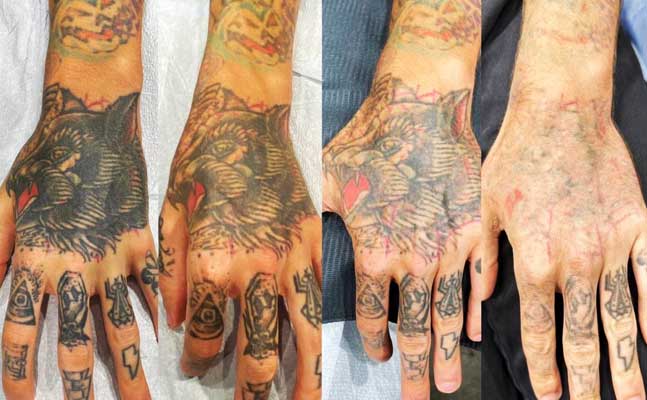 Hand tattoo removed with laser at 1 Point Tattoo