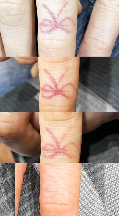 Laser tattoo removal on finger at 1 Point Tattoo