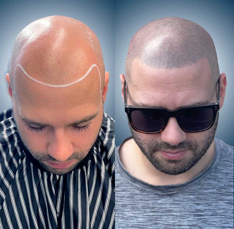 Restore your hairline with scalp micropigmentation at 1 Point Tattoo