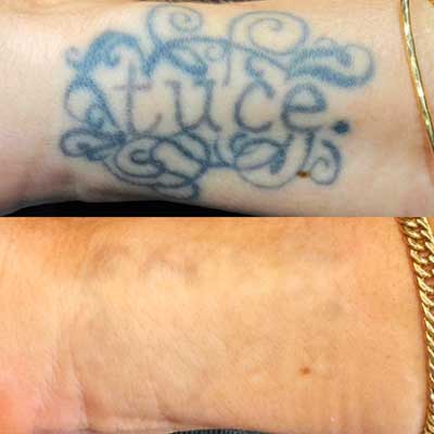 Wrist tattoo removed with laser at 1 Point Tattoo